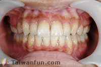 STb "Invisible Braces"