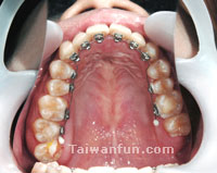 STb "Invisible Braces"